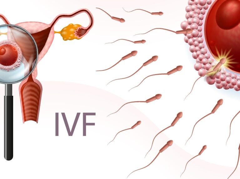 IVF-treatments